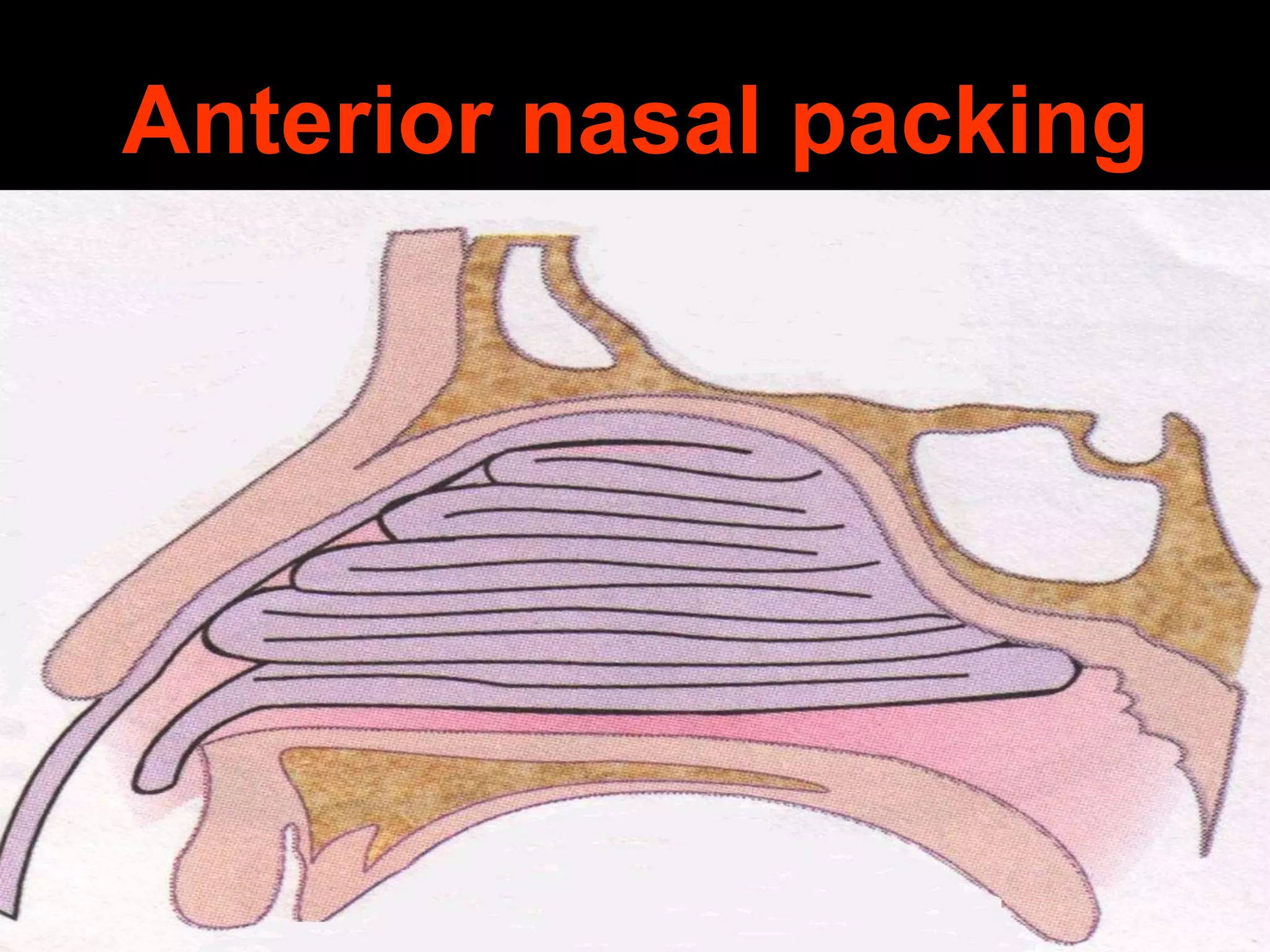 Anterior nasal packing

 