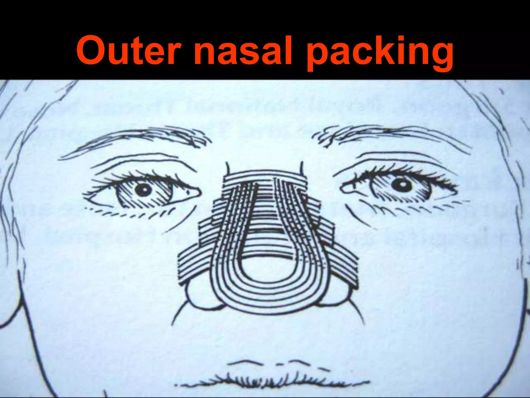 Outer nasal packing

 