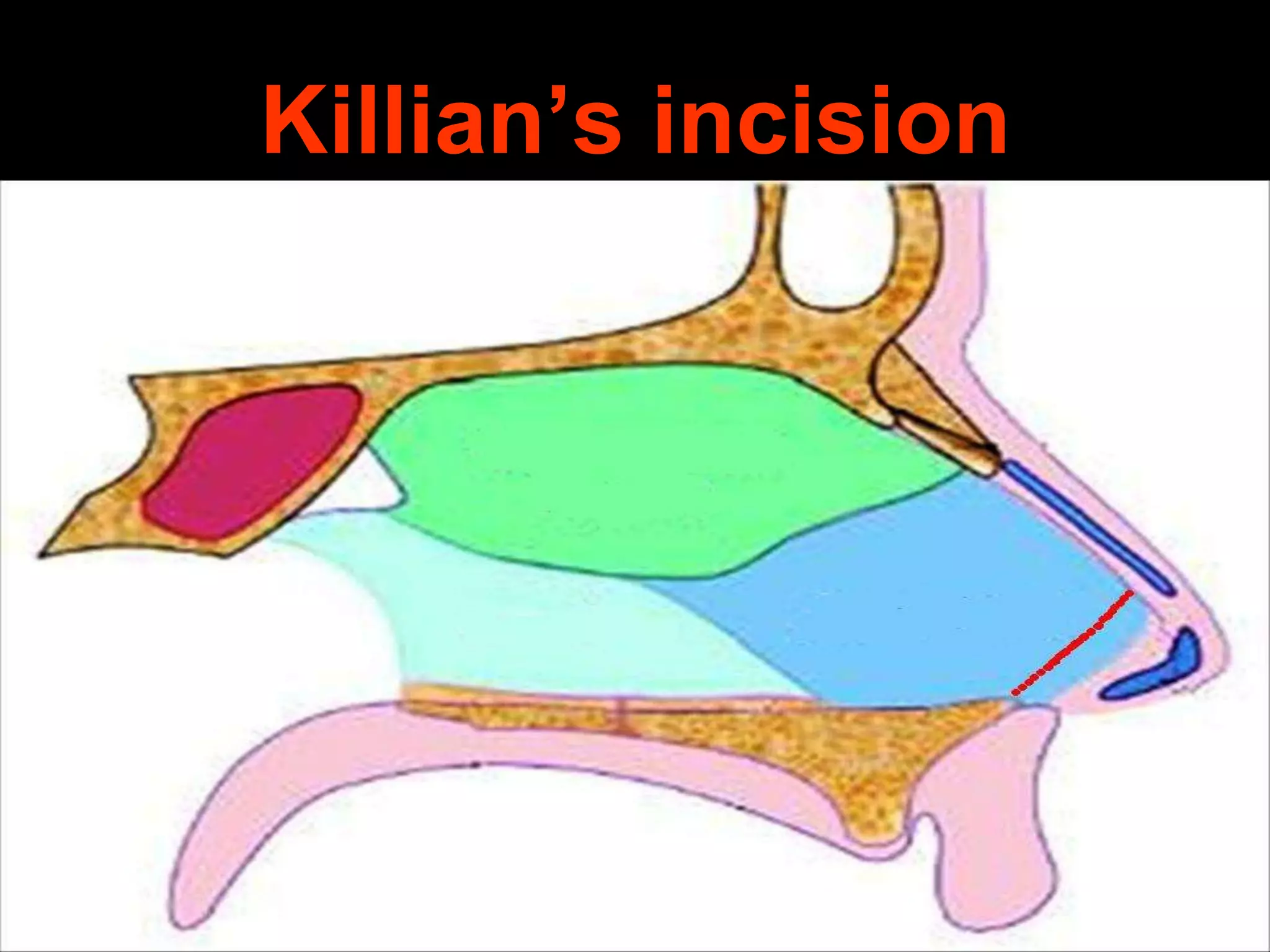 Killian’s incision

 