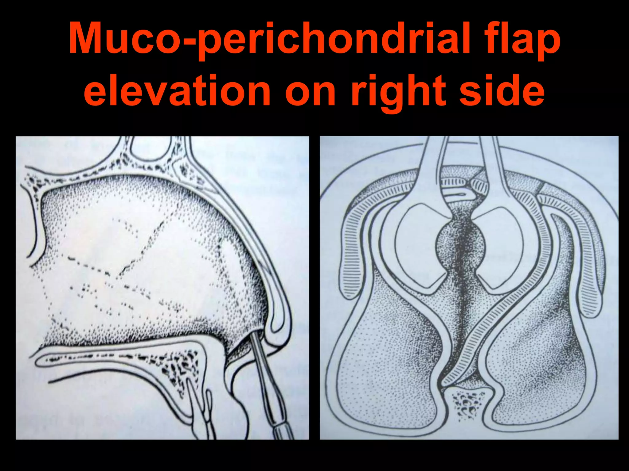 Muco-perichondrial flap
elevation on right side

 