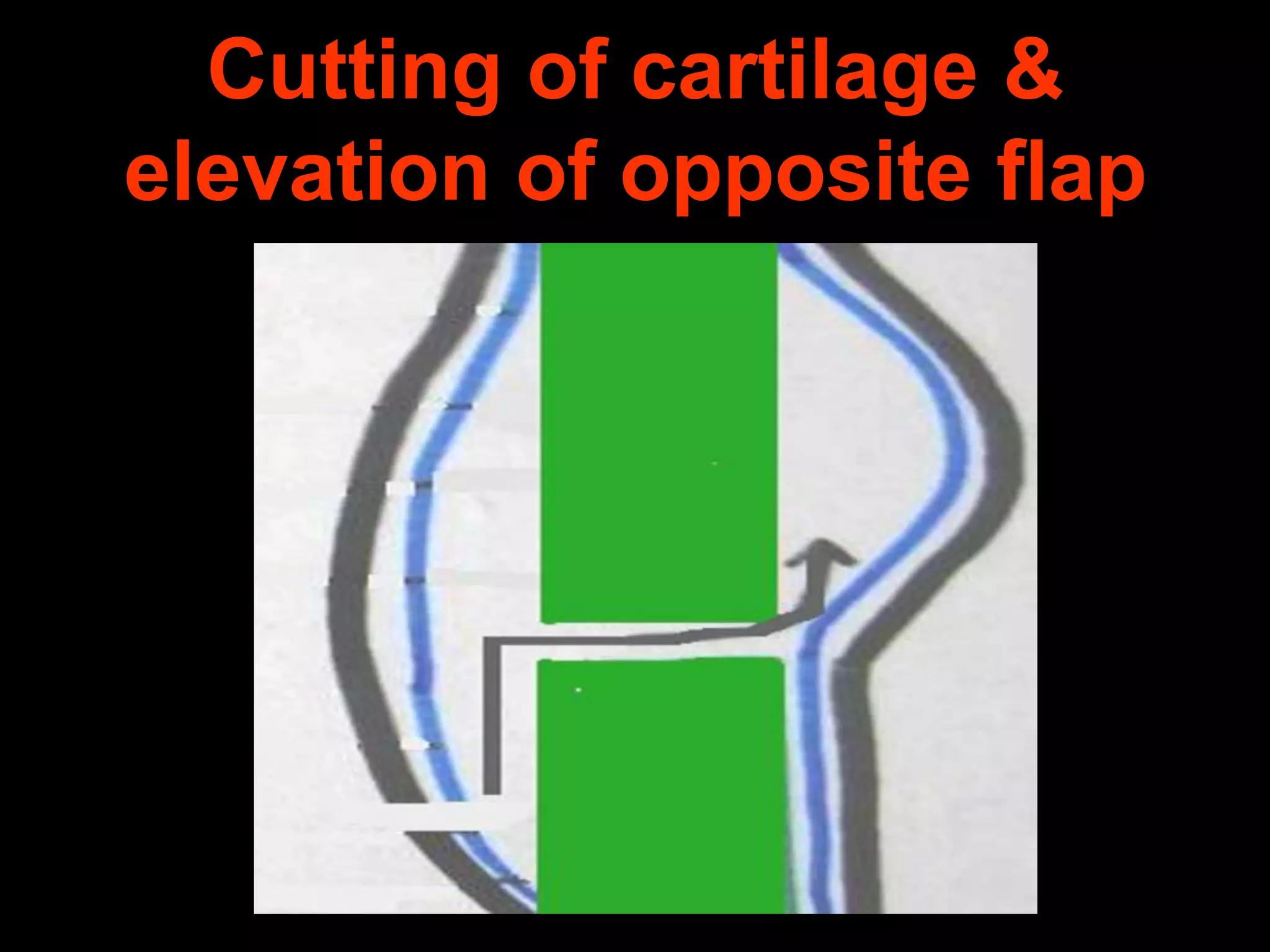 Cutting of cartilage &
elevation of opposite flap

 