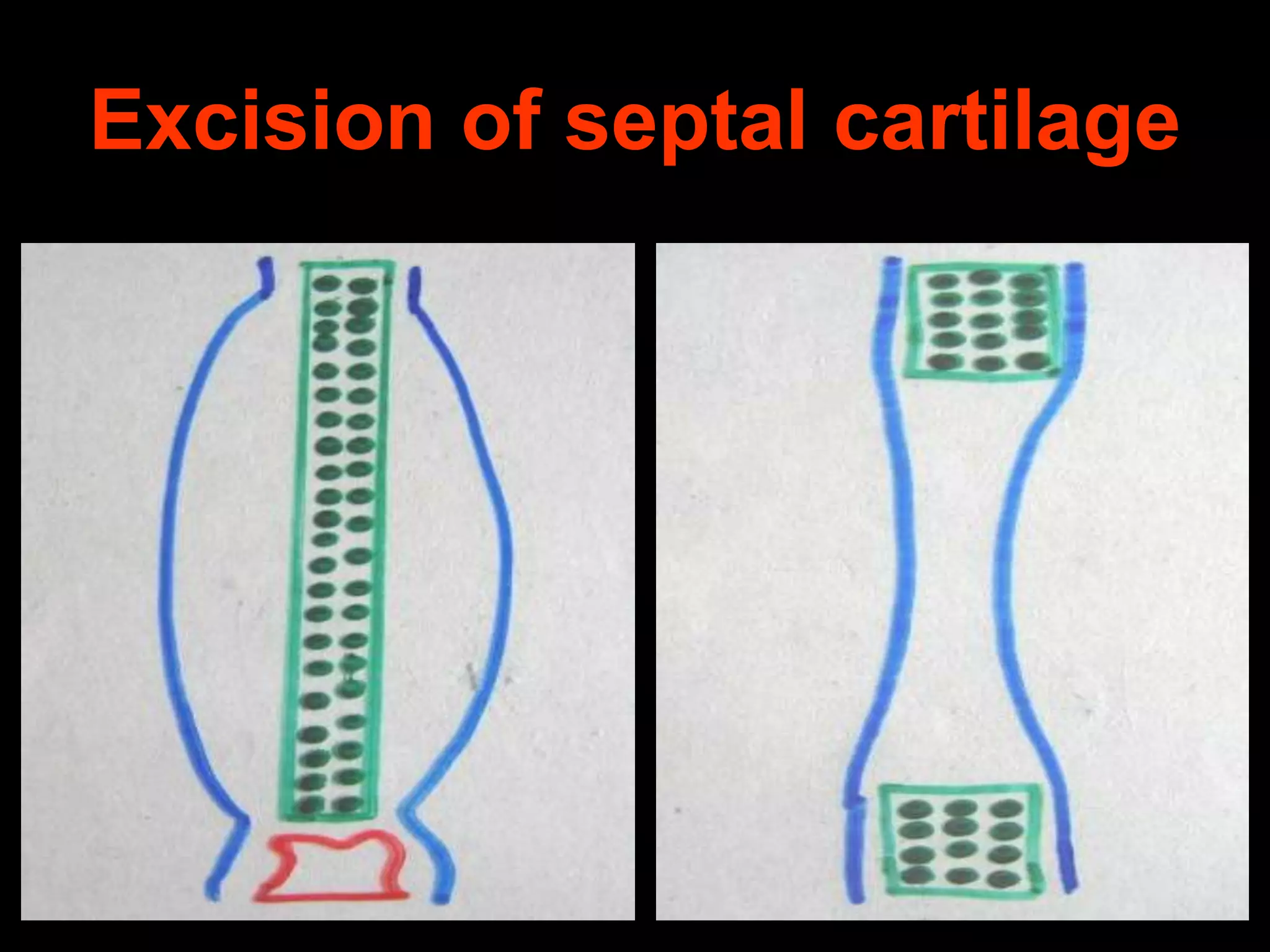 Excision of septal cartilage

 