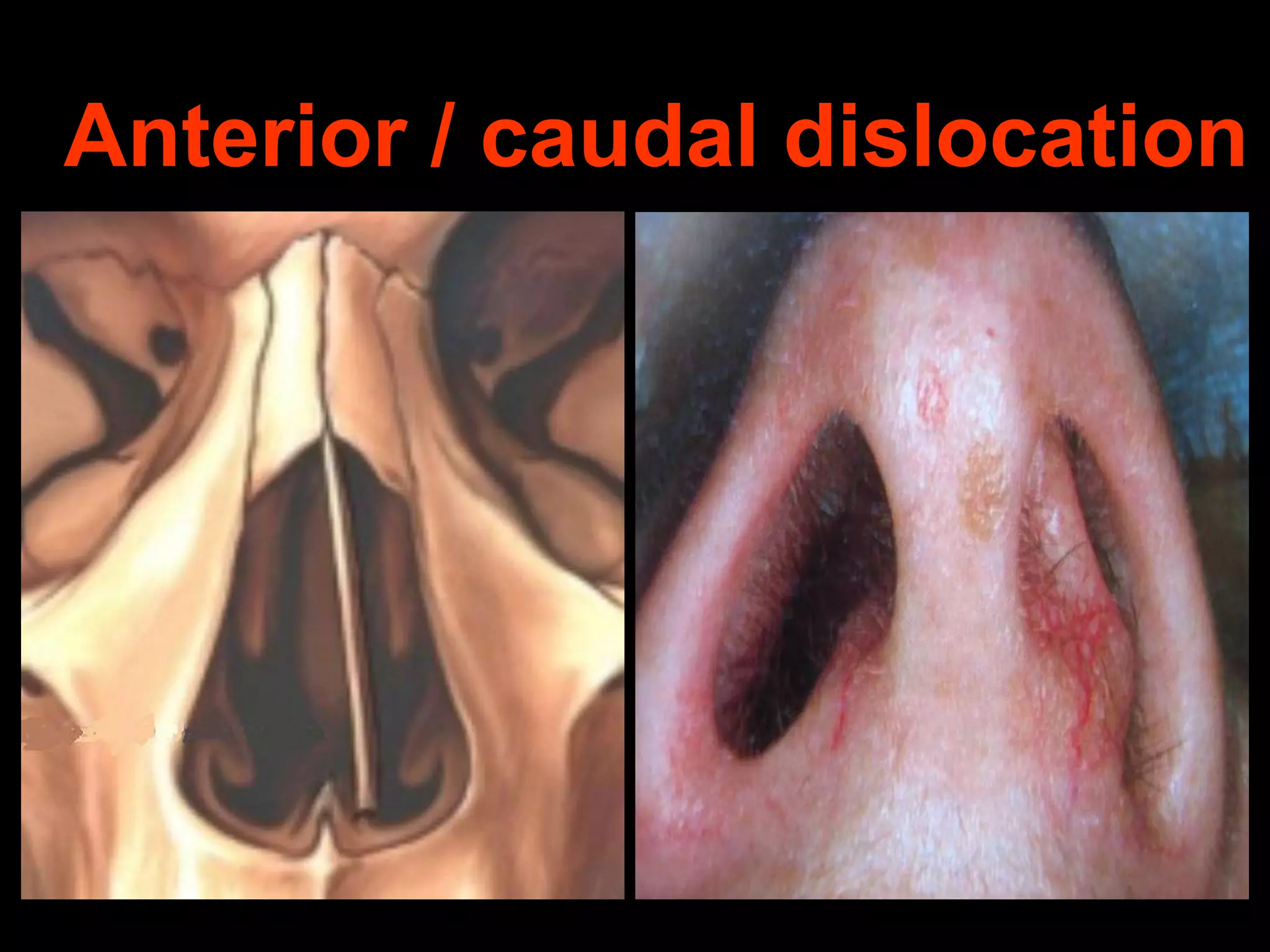 Anterior / caudal dislocation

 