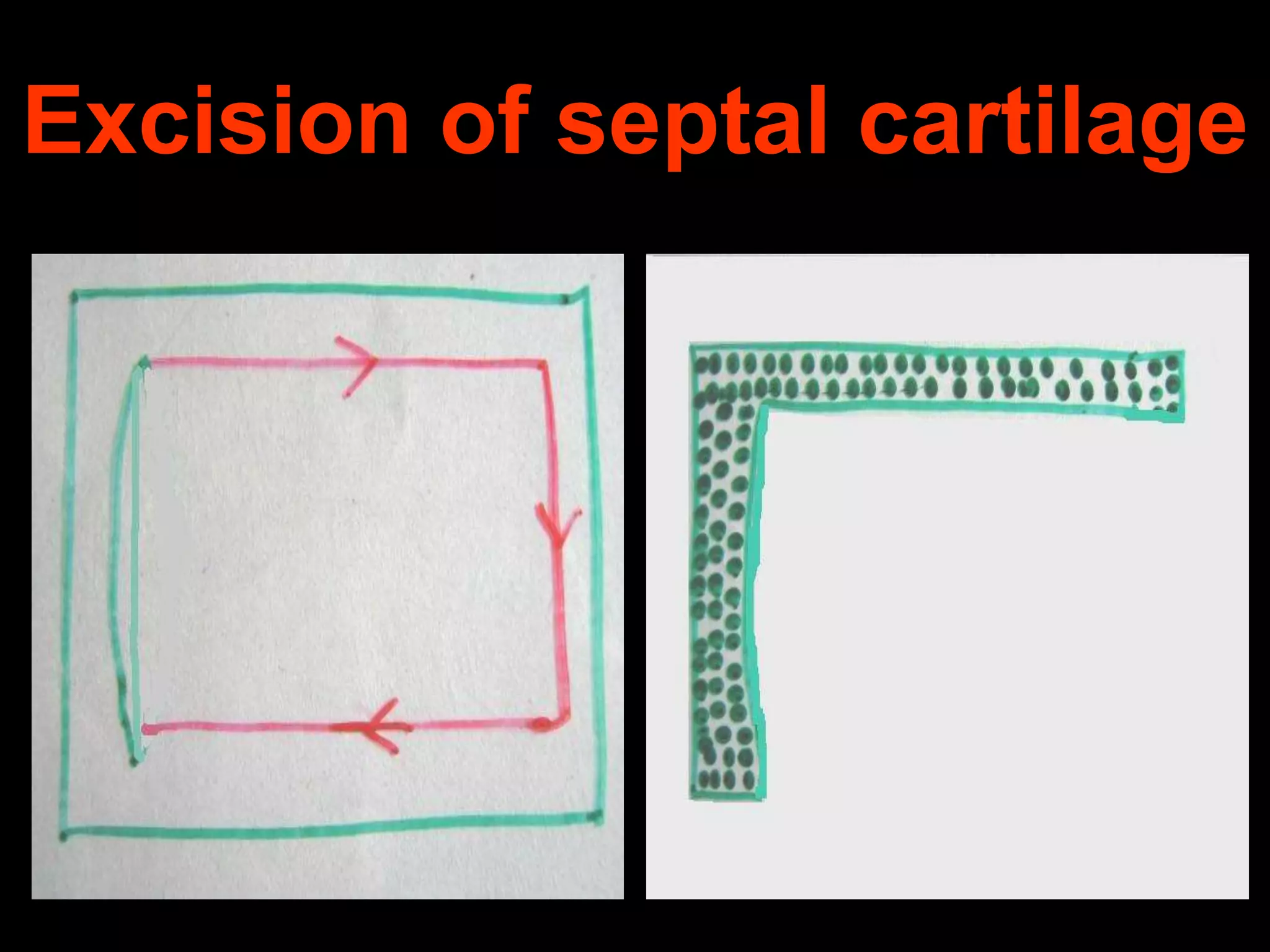 Excision of septal cartilage

 