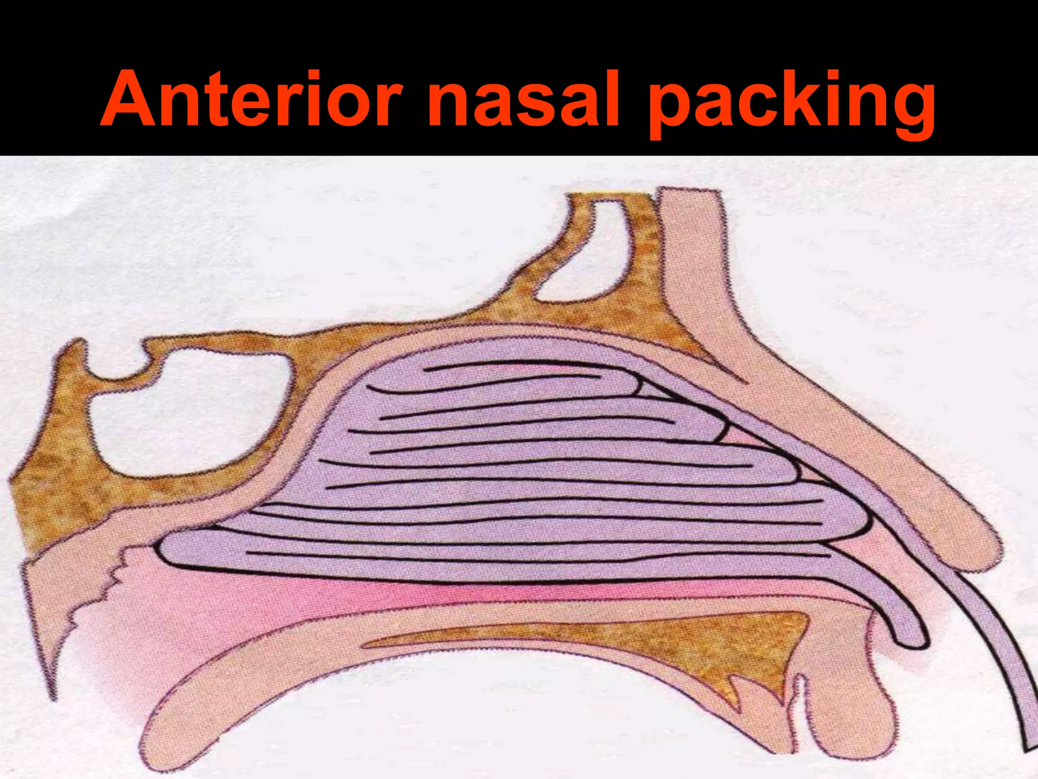 Anterior nasal packing

 