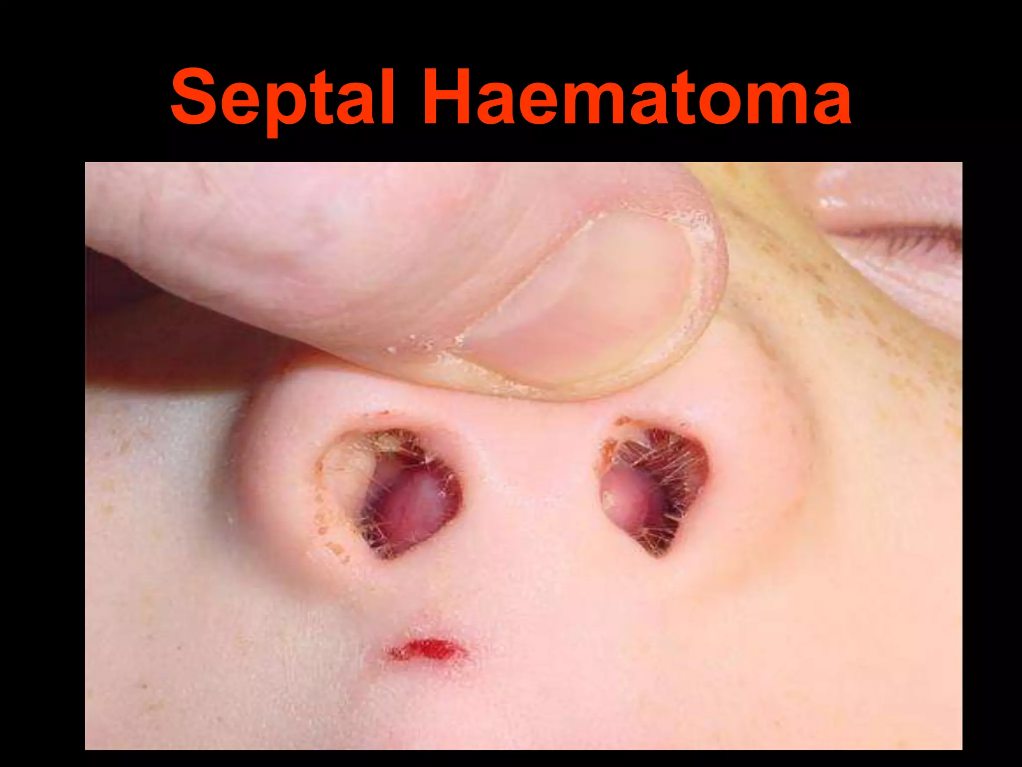 Septal Haematoma

 