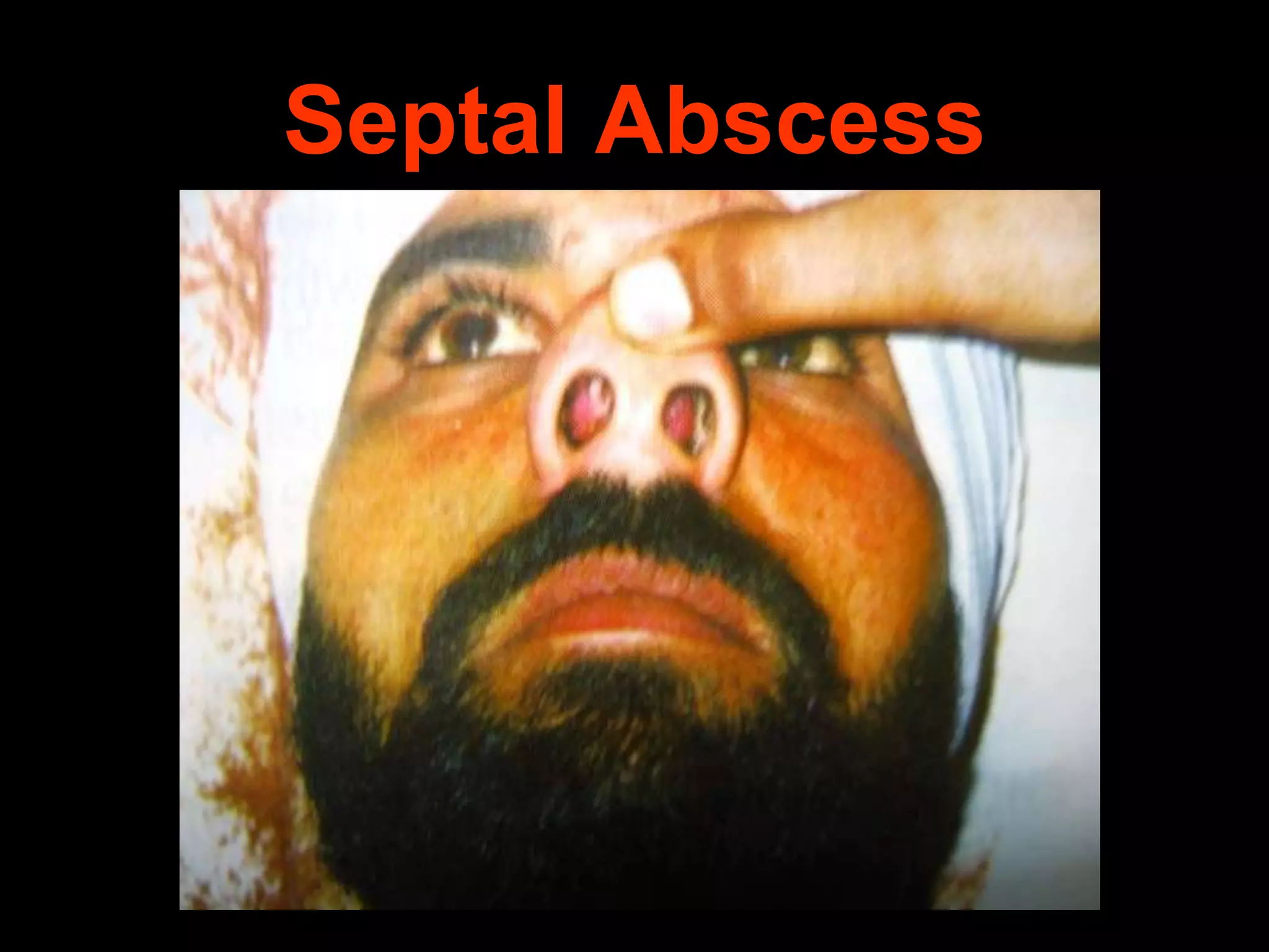 Septal Abscess

 