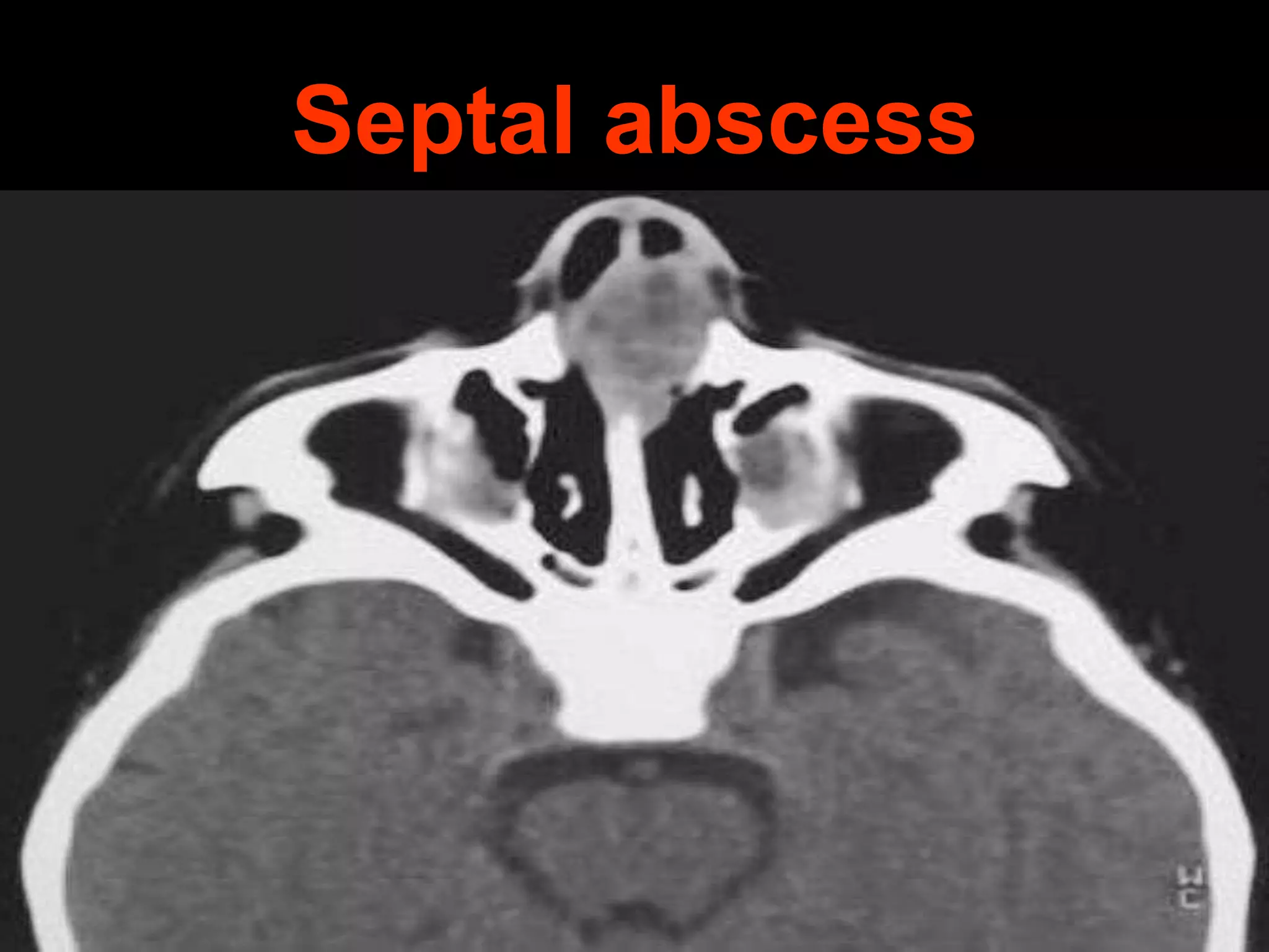 Septal abscess

 