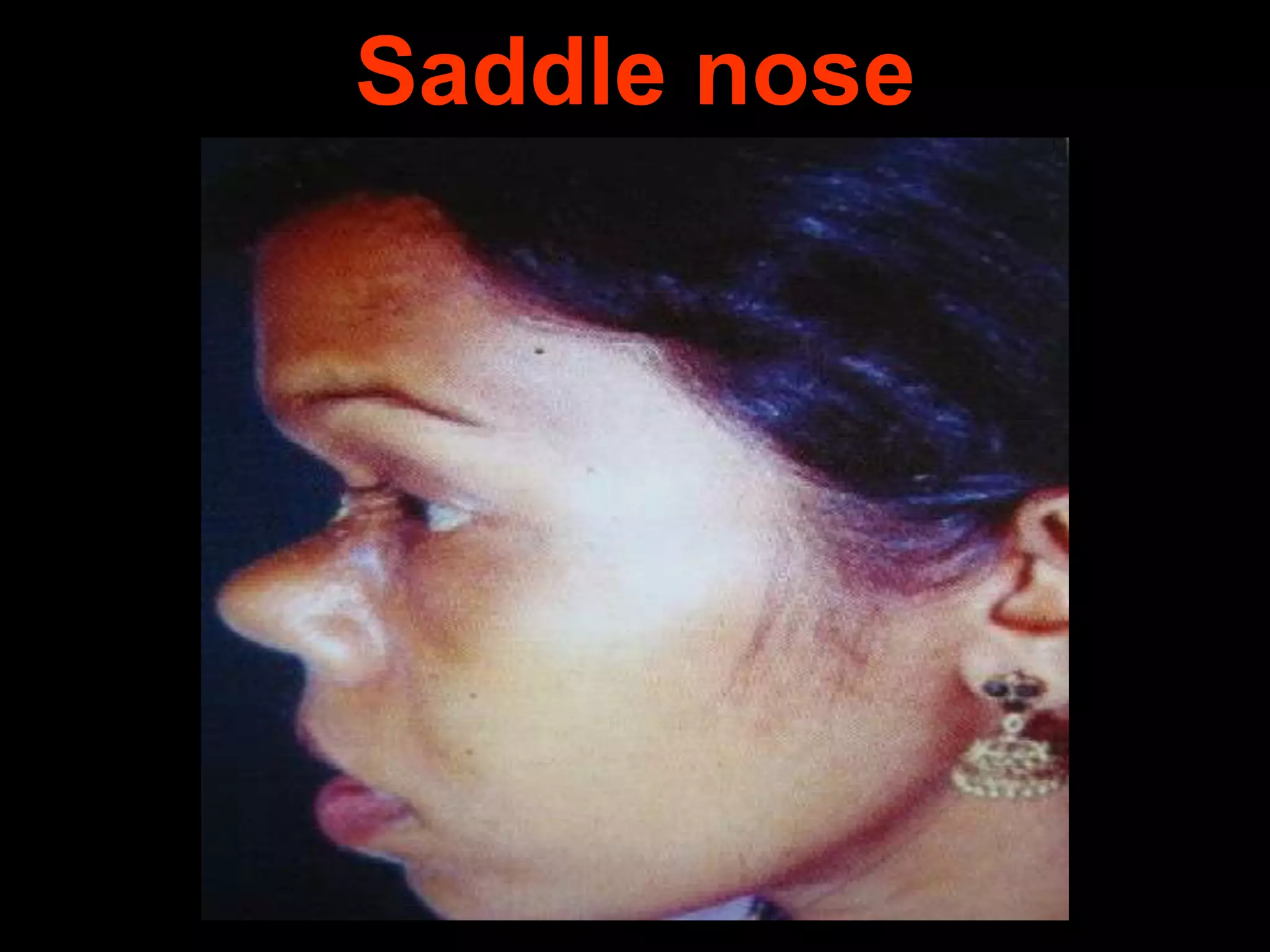 Saddle nose

 