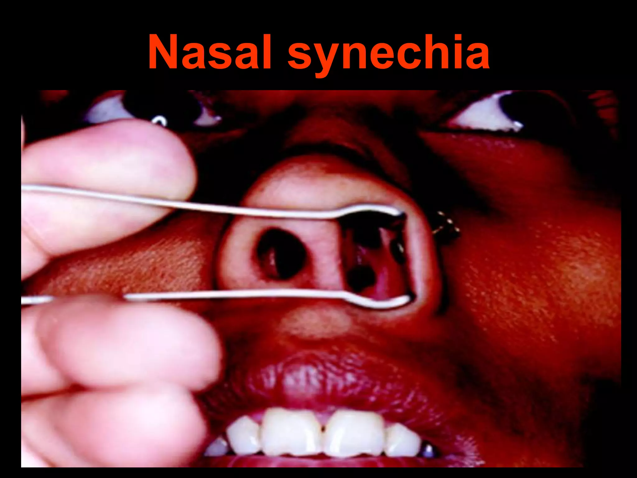 Nasal synechia

 