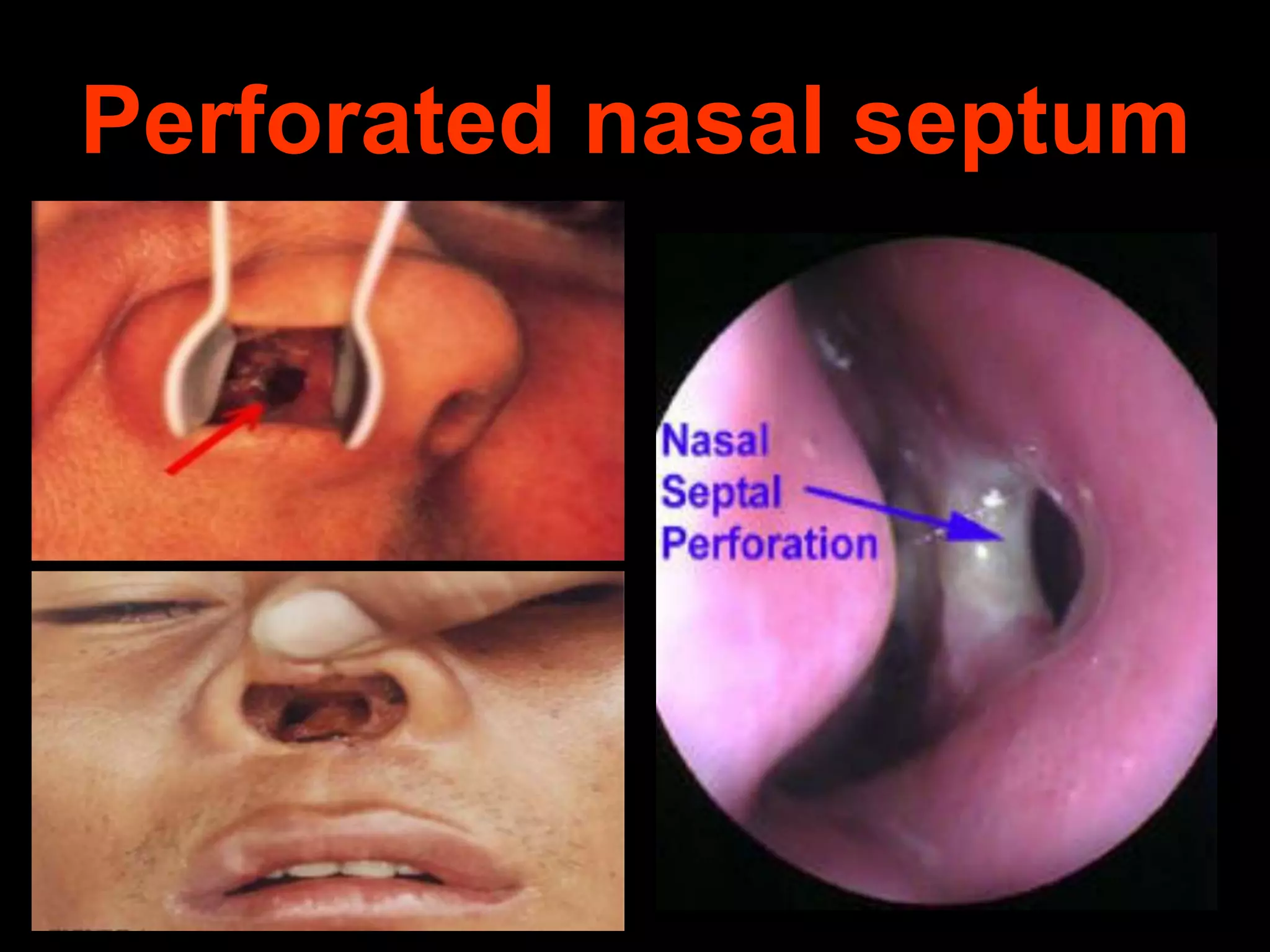 Perforated nasal septum

 