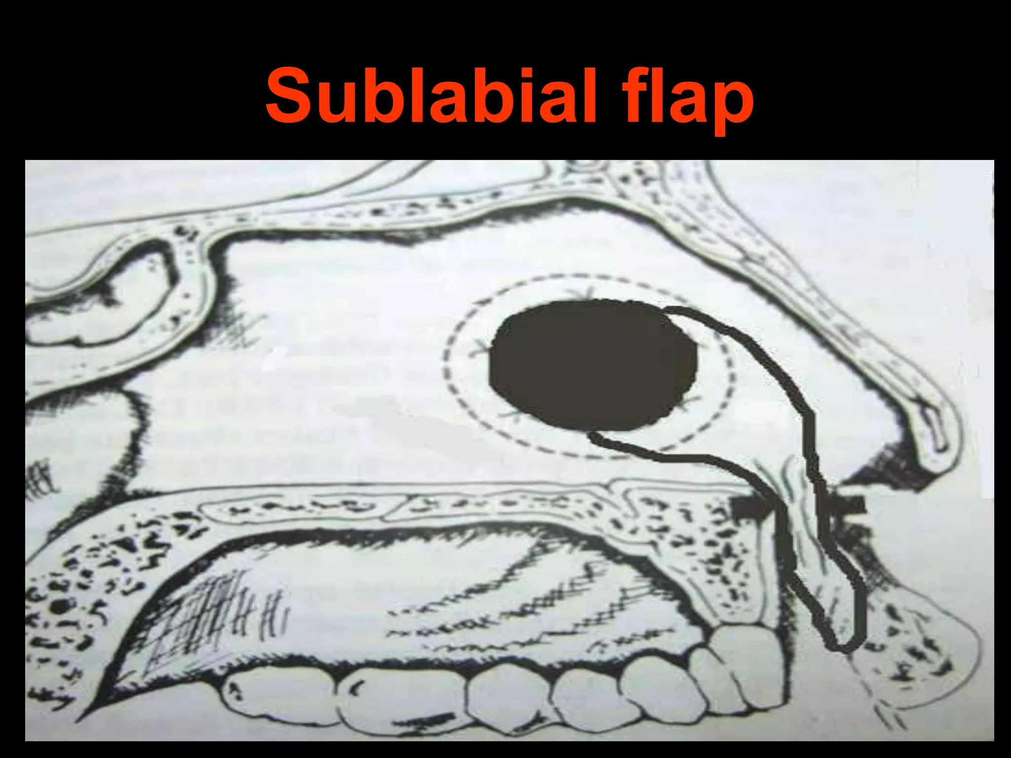 Sublabial flap

 