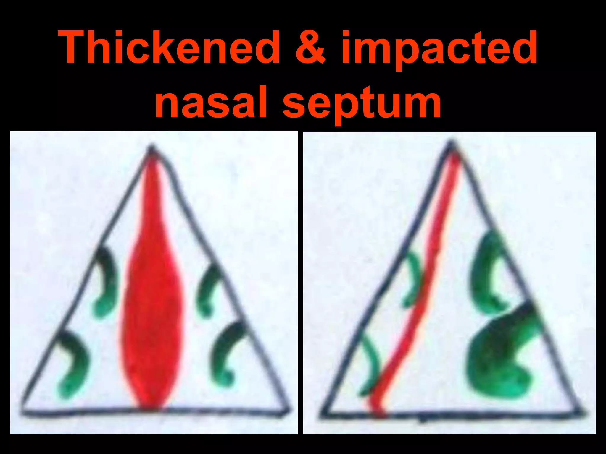 Thickened & impacted
nasal septum

 