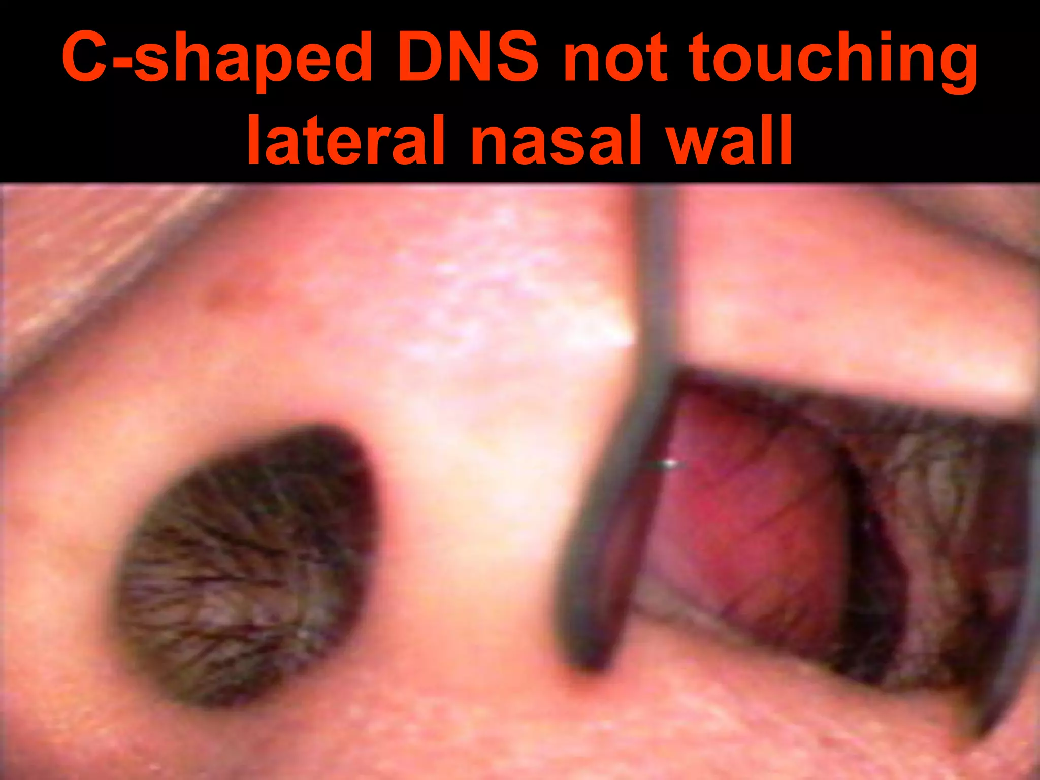 C-shaped DNS not touching
lateral nasal wall

 
