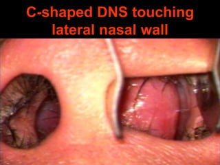 C-shaped DNS touching
lateral nasal wall

 