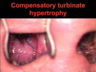 Compensatory turbinate
hypertrophy

 