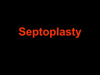 Septoplasty

 