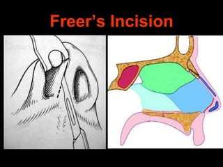 Freer’s Incision

 