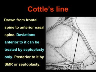 Cottle’s line
Drawn from frontal

spine to anterior nasal
spine. Deviations

anterior to it can be
treated by septoplasty
only. Posterior to it by
SMR or septoplasty.

 