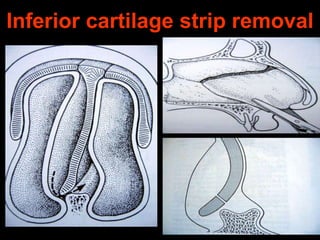 Inferior cartilage strip removal

 