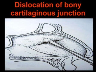 Dislocation of bony
cartilaginous junction

 