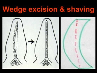 Wedge excision & shaving

 