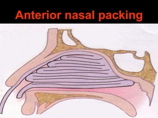 Anterior nasal packing

 