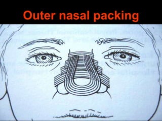 Outer nasal packing

 