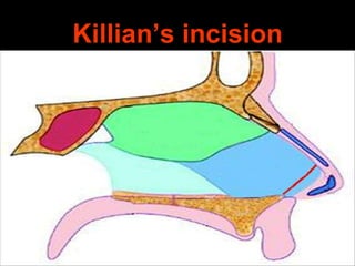 Killian’s incision

 