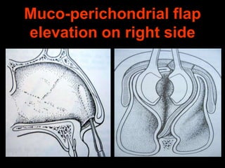 Muco-perichondrial flap
elevation on right side

 