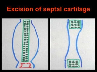 Excision of septal cartilage

 