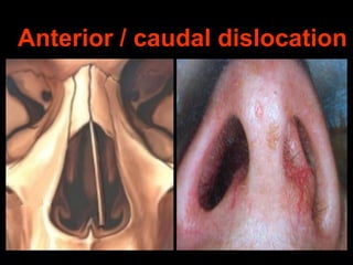 Anterior / caudal dislocation

 