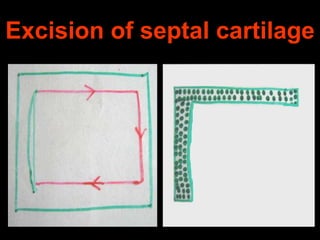 Excision of septal cartilage

 