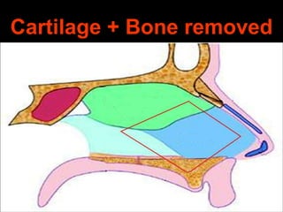 Cartilage + Bone removed

 