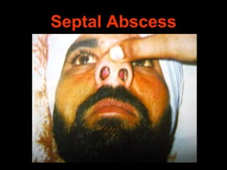 Septal Abscess

 