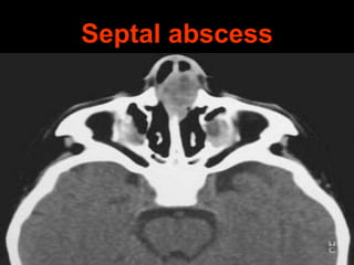 Septal abscess

 