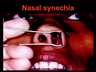 Nasal synechia

 