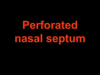 Perforated
nasal septum

 
