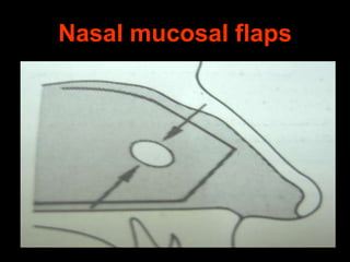 Nasal mucosal flaps

 