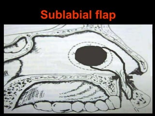 Sublabial flap

 