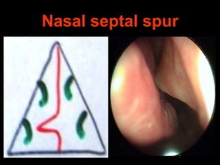Nasal septal spur

 