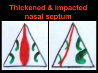 Thickened & impacted
nasal septum

 