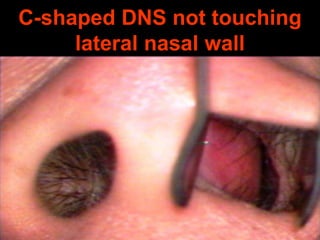 C-shaped DNS not touching
lateral nasal wall

 