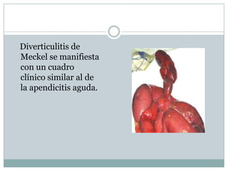 Diverticulitis de
Meckel se manifiesta
con un cuadro
clínico similar al de
la apendicitis aguda.
 