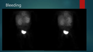 Bleeding
 