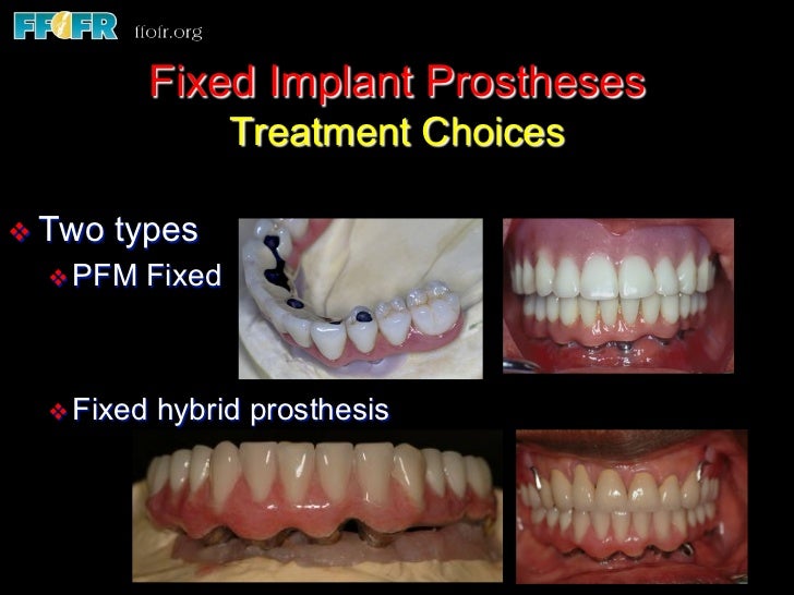 Edentulous Mandible Fixed Prostheses