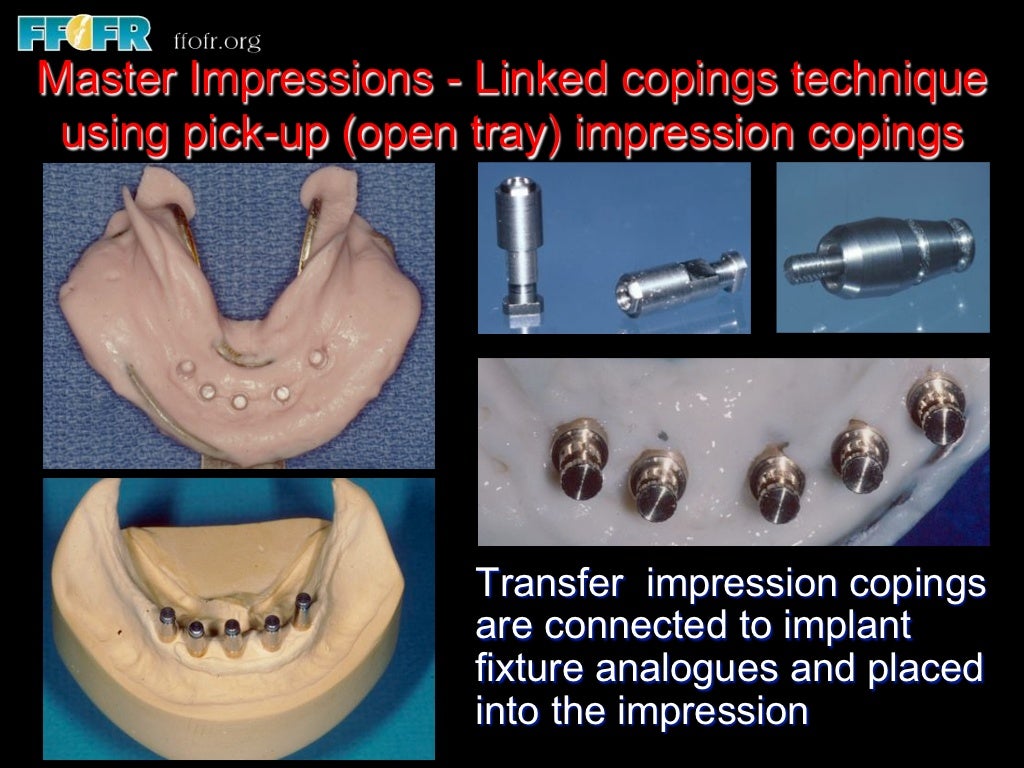 Edentulous Mandible Fixed Prostheses