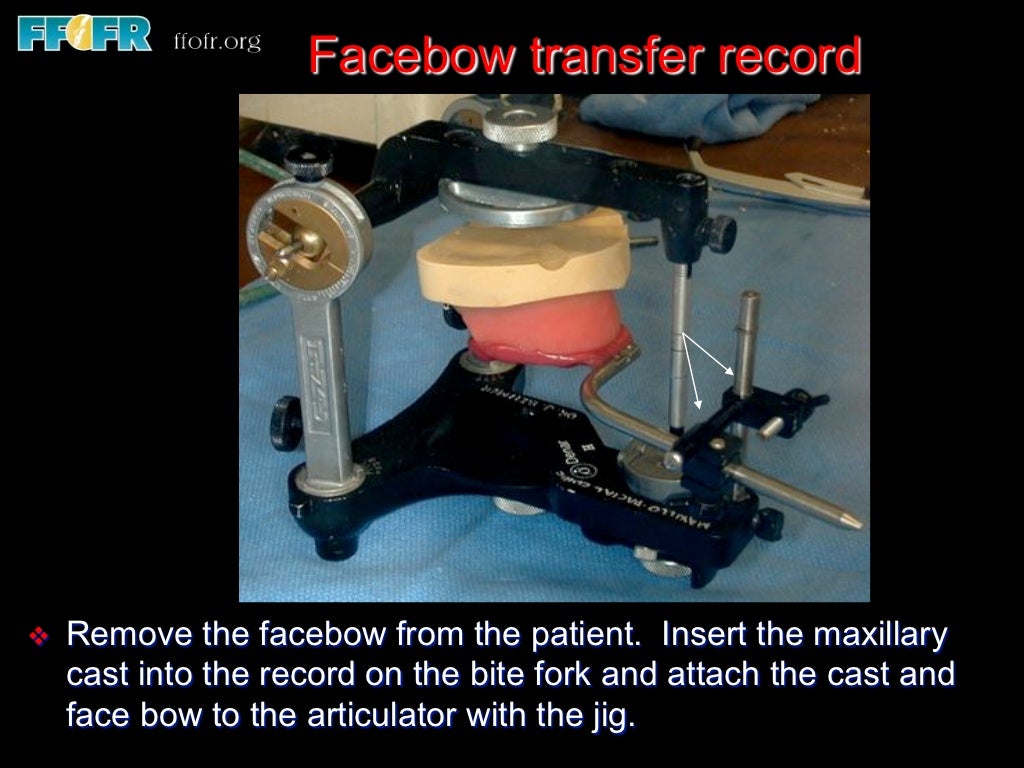 Edentulous Mandible Fixed Prostheses