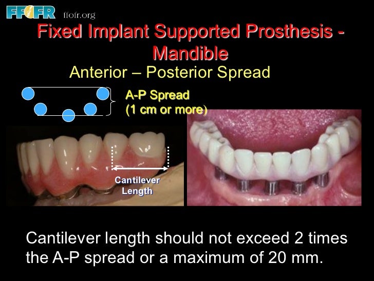 Edentulous Mandible Fixed Prostheses