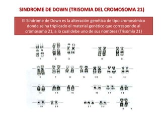 El Síndrome de Down es la alteración genética de tipo cromosómico
donde se ha triplicado el material genético que corresponde al
cromosoma 21, a lo cual debe uno de sus nombres (Trisomía 21)
SINDROME DE DOWN (TRISOMIA DEL CROMOSOMA 21)
 